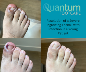 Side-by-side images showing a patient’s toe before and after nail surgery—initial image displays an inflamed, ingrown toenail, while the post-surgery image shows a clean, healing nail bed with reduced redness.