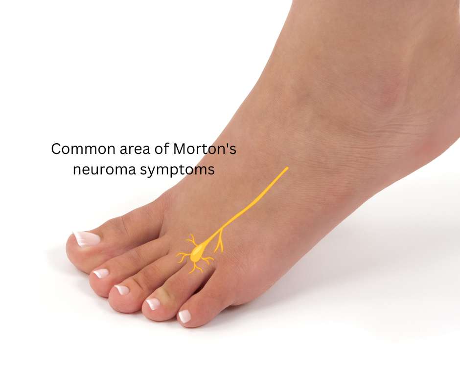 Illustration showing the typical location of Morton's neuroma in the forefoot
