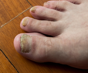 A discoloured fungal toenail separating from the nail bed.